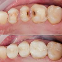 Treatment of Dental Cavities