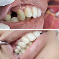 Teeth Replacement
