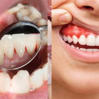 Gum Treatments