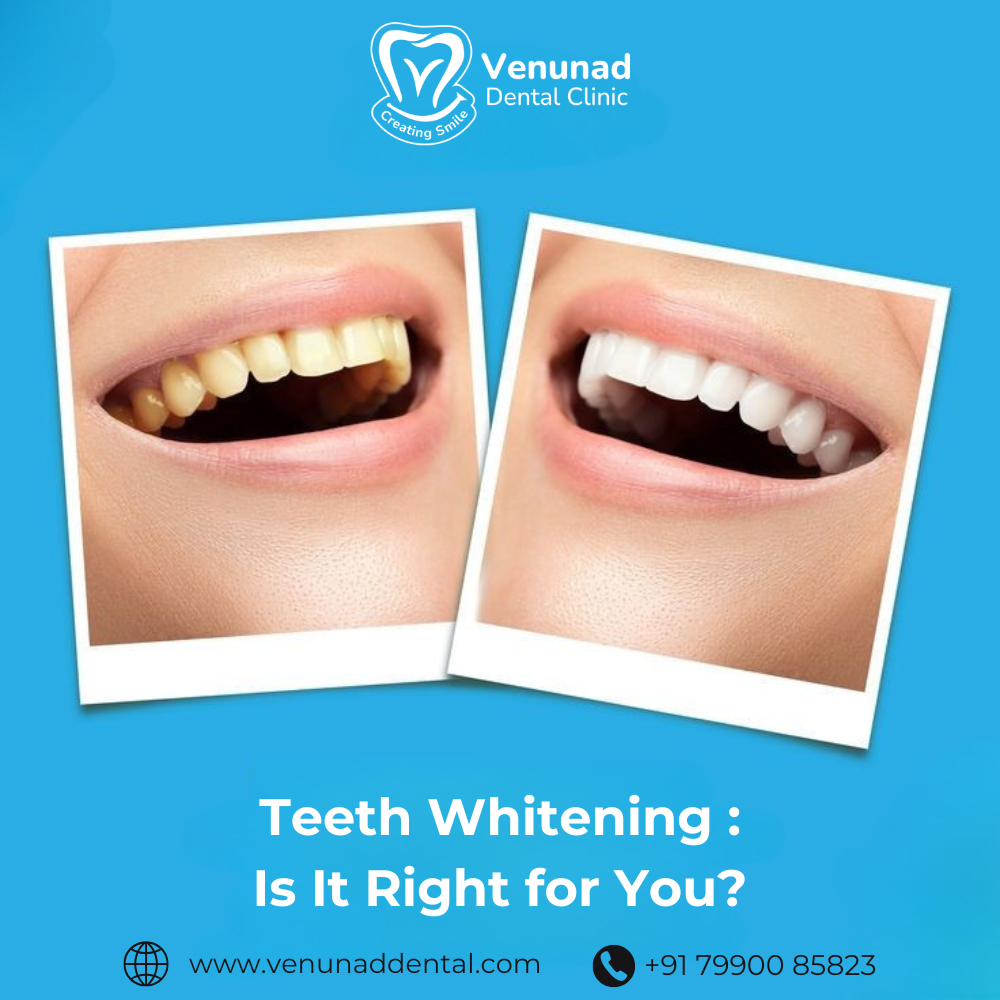 https://venunaddental.com.lttrbx.in/uploaded_file/files/img/news/Teeth Whitening